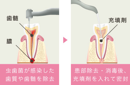 虫歯菌が感染した歯質や歯髄を除去、患部除去・消毒後、充填剤を入れて密封